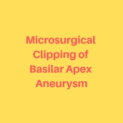 Microsurgical-Clipping-of-Basilar-Apex-Aneurysm